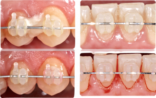 Guided Biofilm Therapy – La testimonianza della Dott.ssa Maria Laura Cuzzocrea