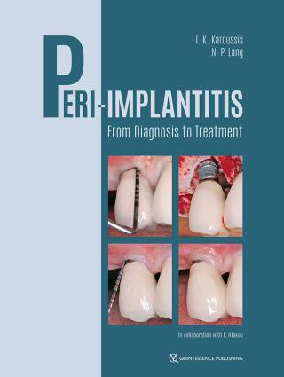 Peri-implantitis - From diagnosis to treatment